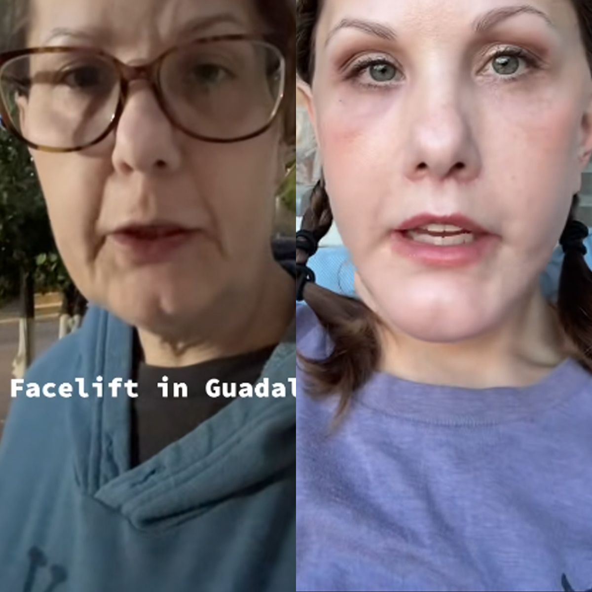 TikToker Michelle Wood Before-and-After Facelift Photos Have Fans in Disbelief