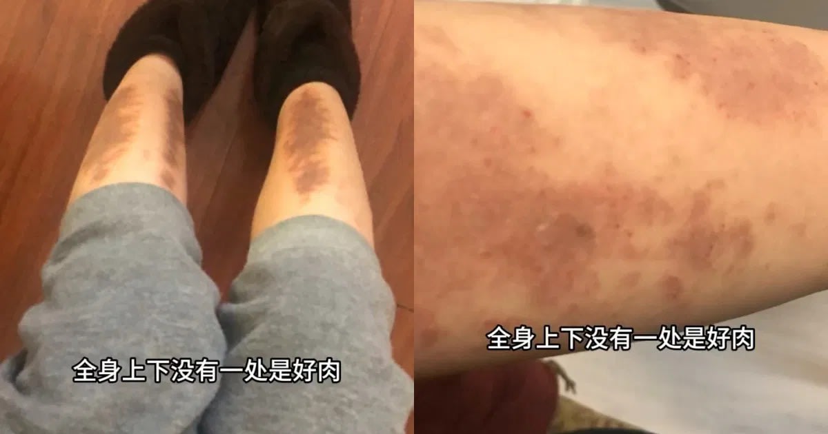 被好友骗光积蓄，港星陈思齐全身长满疹子！