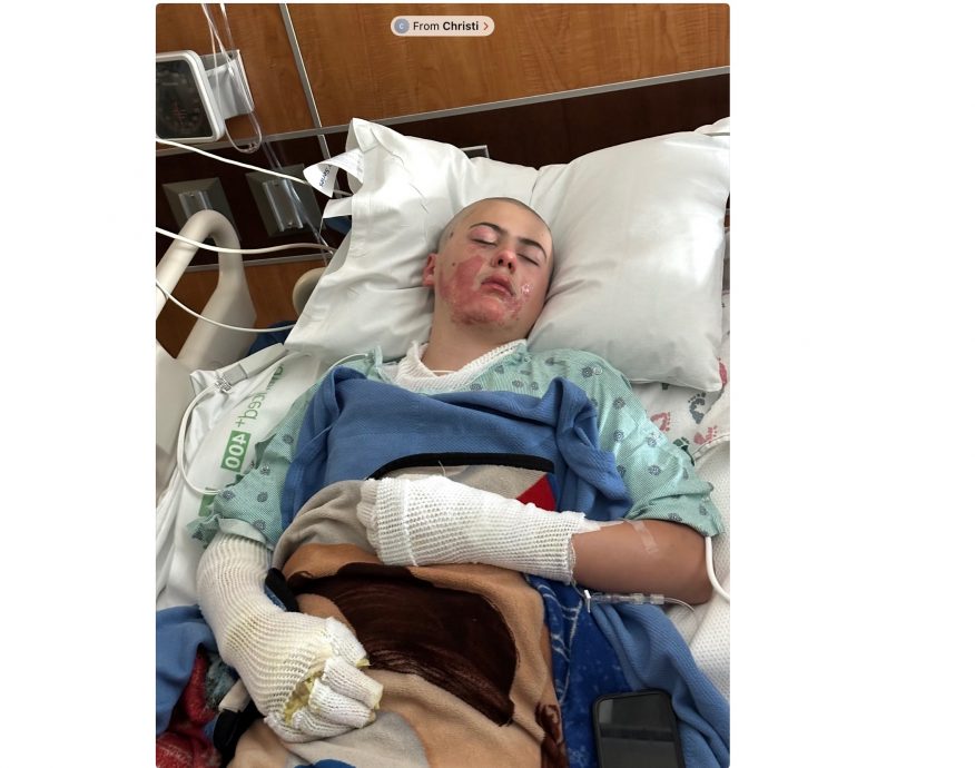 12岁少年学网上影片“挑战玩火实验”！下一秒火燃全身⚡家人发起「线上募款」凑治疗费！