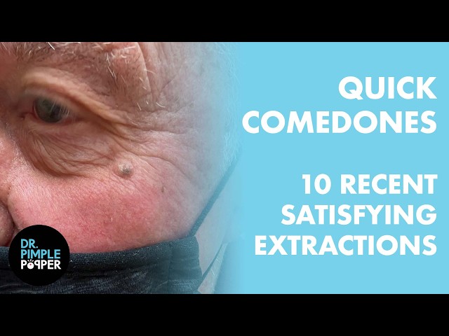QUICK COMEDONES: 10 Recent, Satisfying Extractions