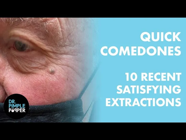 QUICK COMEDONES: 10 Recent, Satisfying Extractions