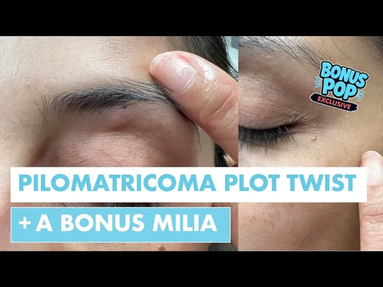 ALL ACCESS EXCLUSIVE | The Pilmatricoma Plot Twist + Bonus Milia Pop 💥