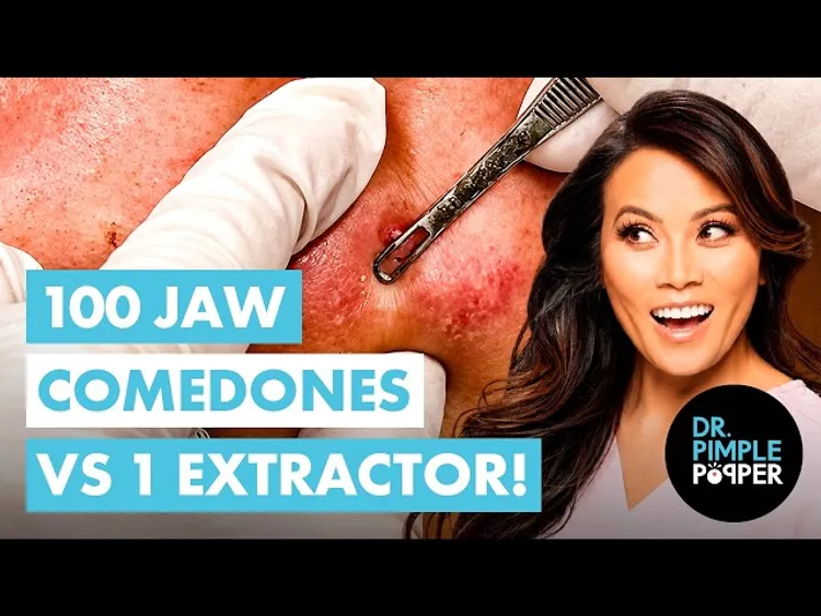 100 Jaw Comedones vs 1 Extractor!