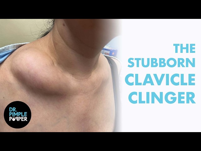 THE STUBBORN CLAVICLE CLINGER | Dr. Pimple Popper vs. a Large Lipoma