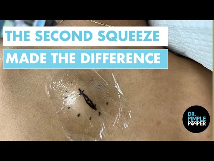 The Second Squeeze Made The Difference | Epidermoid Cyst Removal